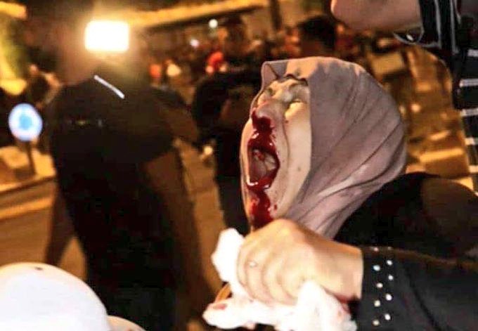 امرأة من القدس أصيبت بفعل المواجهات مع الاحتلال الصهيوني